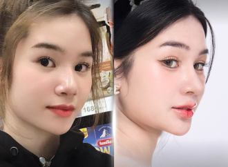 Nâng Mũi Đẹp Tự Nhiên, An Toàn Chuẩn Y Khoa tại Long Khánh – Thẩm Mỹ Viện Bác Sĩ Kim Hà